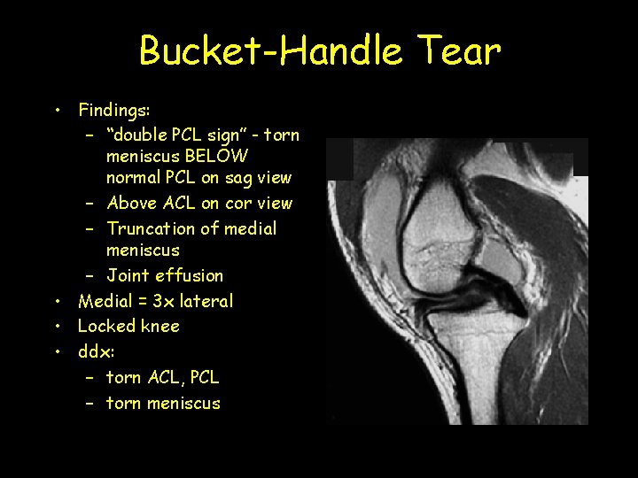 Bucket-Handle Tear • Findings: – “double PCL sign” - torn meniscus BELOW normal PCL