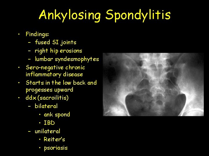 Ankylosing Spondylitis • Findings: – fused SI joints – right hip erosions – lumbar