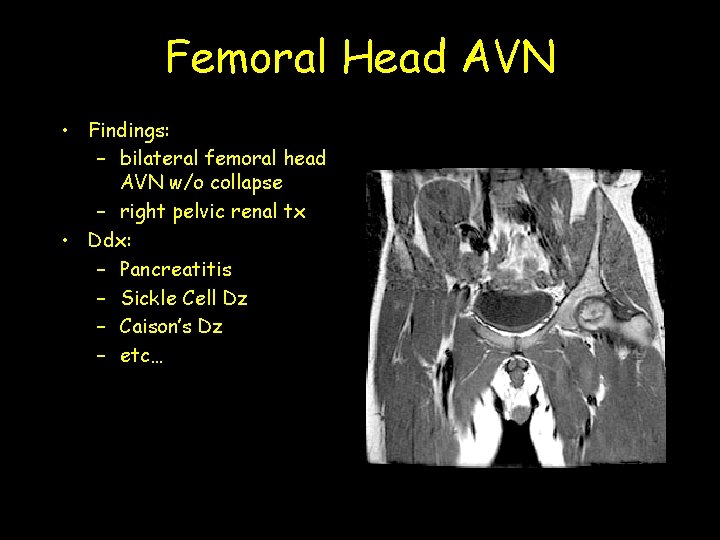 Femoral Head AVN • Findings: – bilateral femoral head AVN w/o collapse – right