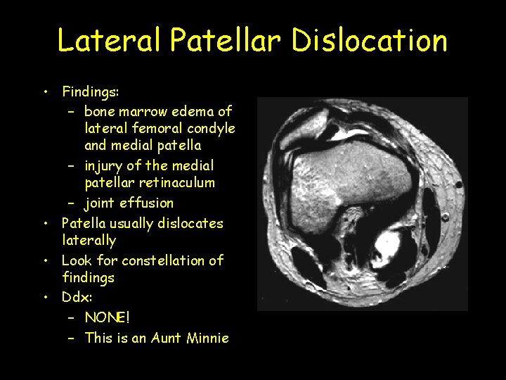 Lateral Patellar Dislocation • Findings: – bone marrow edema of lateral femoral condyle and