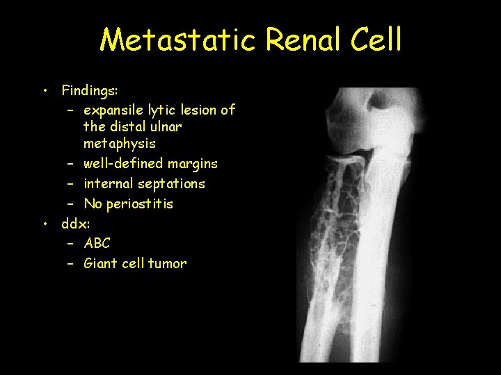 Metastatic Renal Cell • Findings: – expansile lytic lesion of the distal ulnar metaphysis