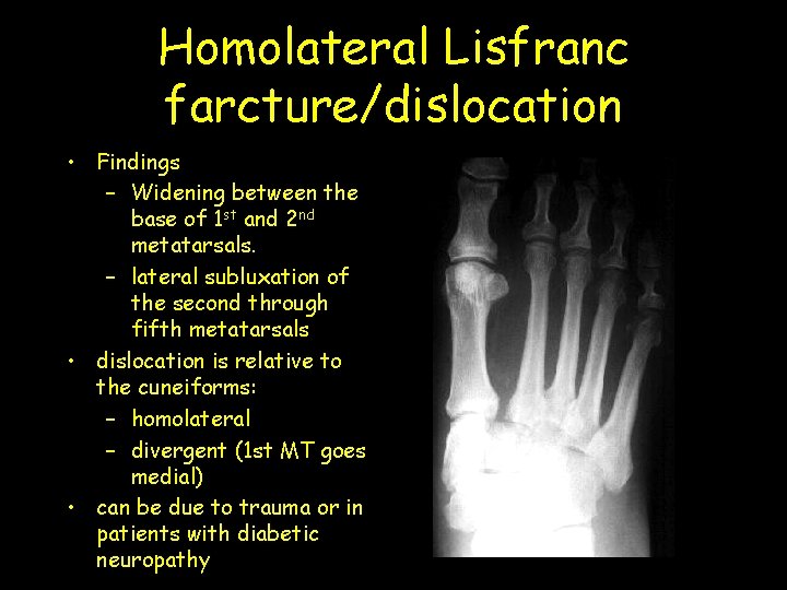 Homolateral Lisfranc farcture/dislocation • Findings – Widening between the base of 1 st and