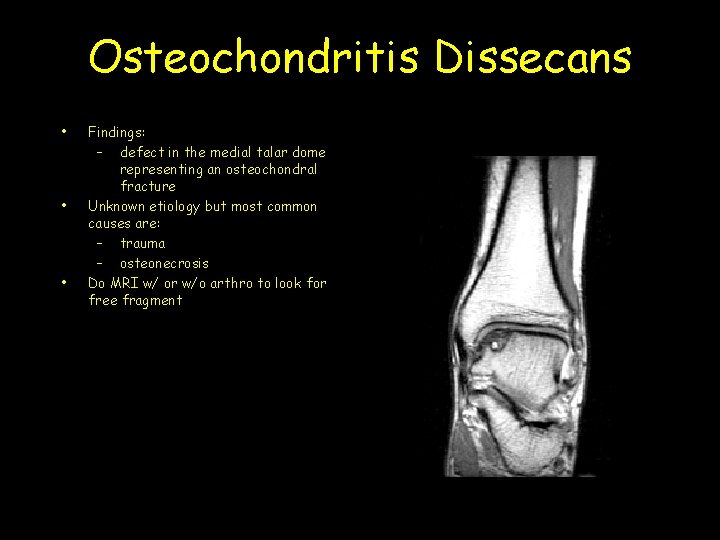 Osteochondritis Dissecans • • • Findings: – defect in the medial talar dome representing