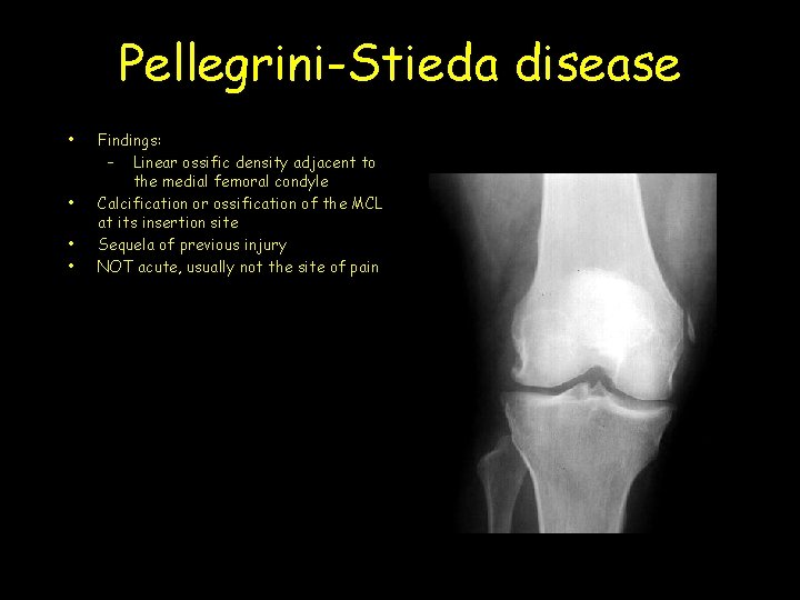 Pellegrini-Stieda disease • • Findings: – Linear ossific density adjacent to the medial femoral