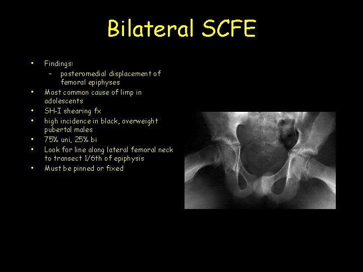 Bilateral SCFE • • Findings: – posteromedial displacement of femoral epiphyses Most common cause