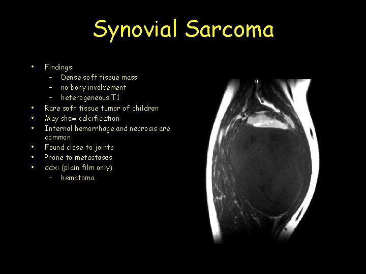 Synovial Sarcoma • • Findings: – Dense soft tissue mass – no bony involvement