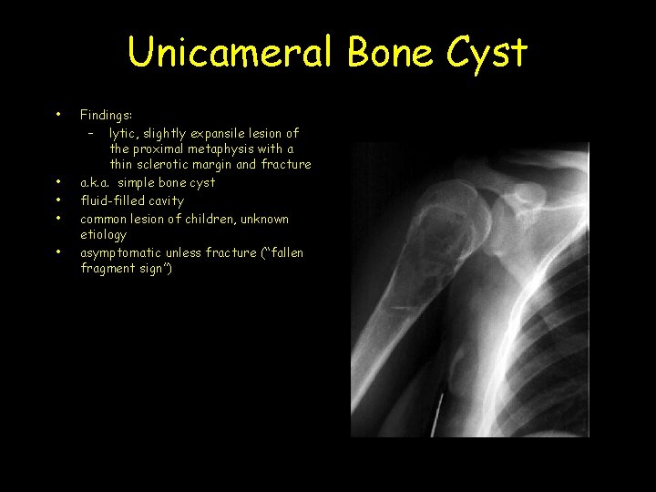 Unicameral Bone Cyst • • • Findings: – lytic, slightly expansile lesion of the