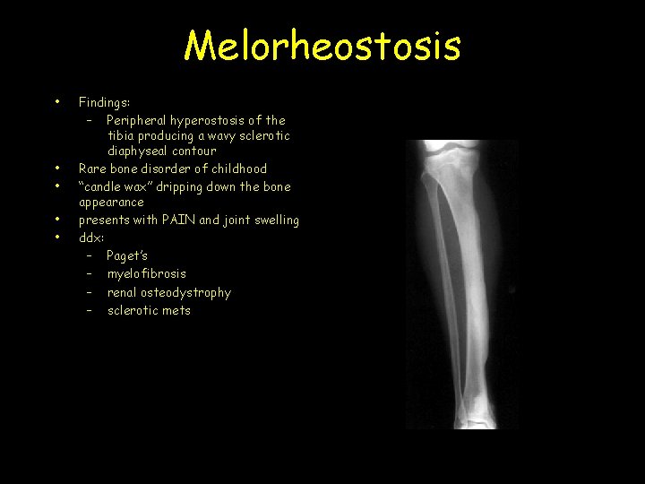 Melorheostosis • • • Findings: – Peripheral hyperostosis of the tibia producing a wavy