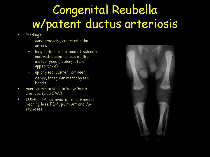 Congenital Reubella w/patent ductus arteriosis • • • Findings: – cardiomegaly, enlarged pulm arteries