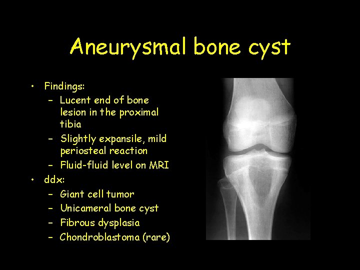 Aneurysmal bone cyst • Findings: – Lucent end of bone lesion in the proximal