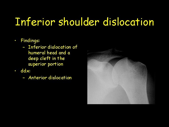 Inferior shoulder dislocation • Findings: – Inferior dislocation of humeral head and a deep