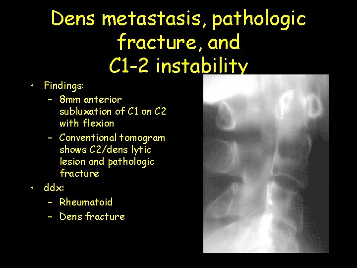 Dens metastasis, pathologic fracture, and C 1 -2 instability • Findings: – 8 mm