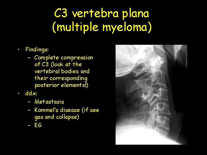 C 3 vertebra plana (multiple myeloma) • Findings: – Complete compression of C 3