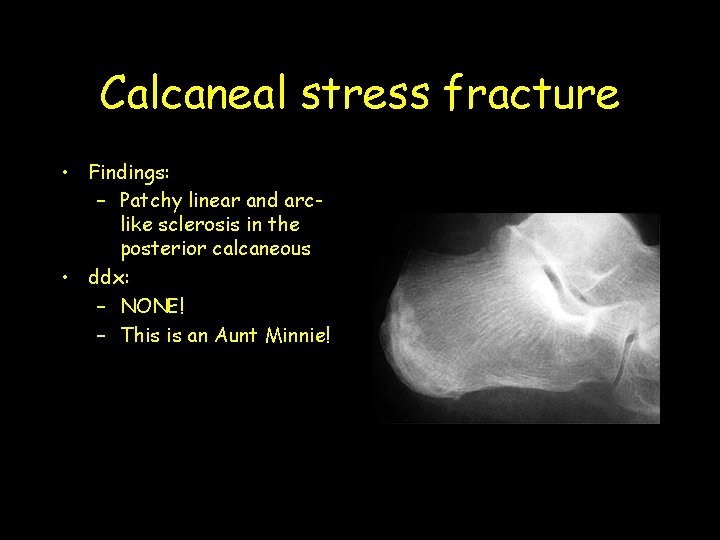 Calcaneal stress fracture • Findings: – Patchy linear and arclike sclerosis in the posterior