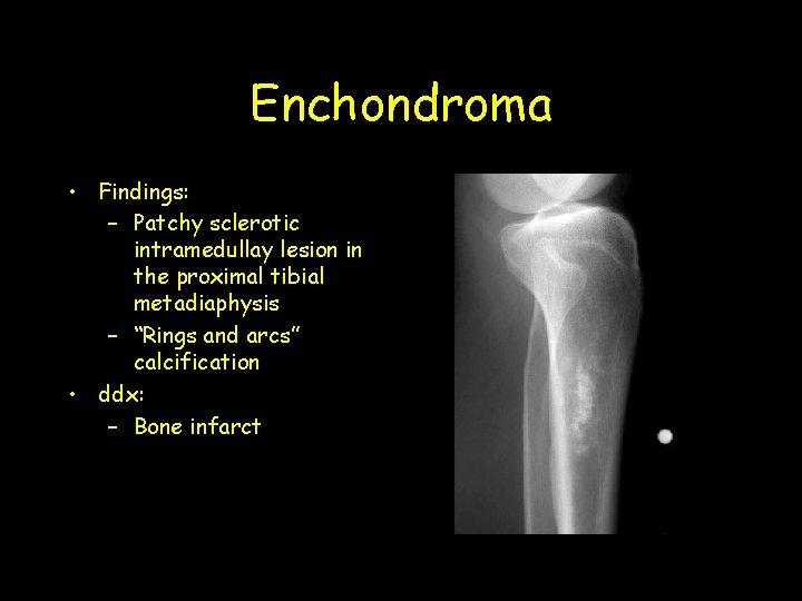 Enchondroma • Findings: – Patchy sclerotic intramedullay lesion in the proximal tibial metadiaphysis –