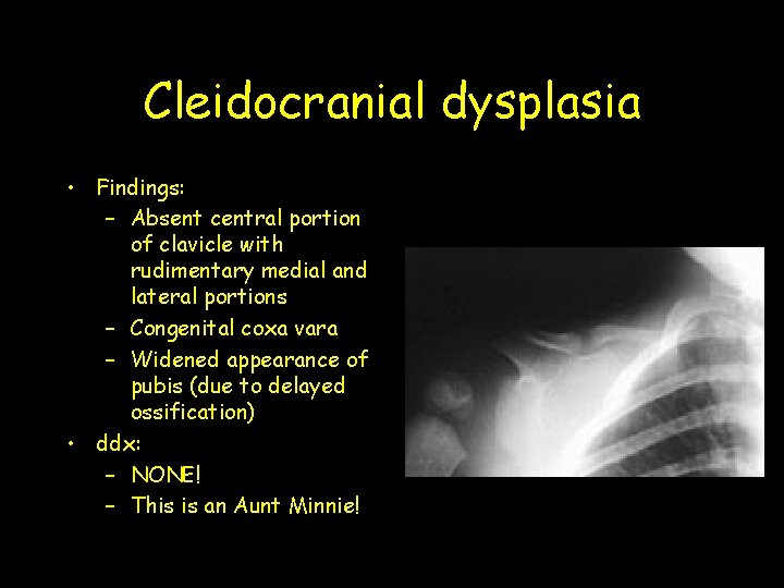 Cleidocranial dysplasia • Findings: – Absent central portion of clavicle with rudimentary medial and