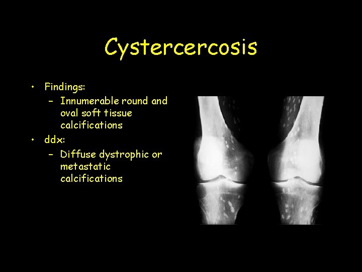 Cystercercosis • Findings: – Innumerable round and oval soft tissue calcifications • ddx: –