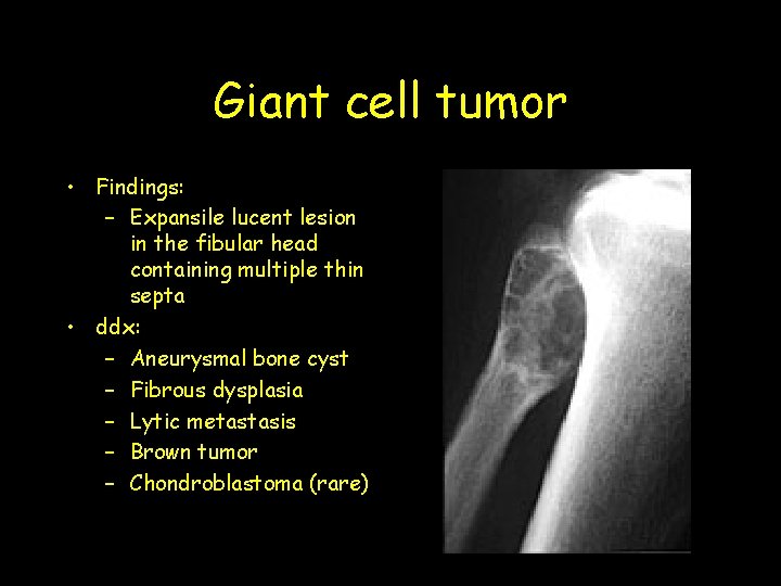 Giant cell tumor • Findings: – Expansile lucent lesion in the fibular head containing