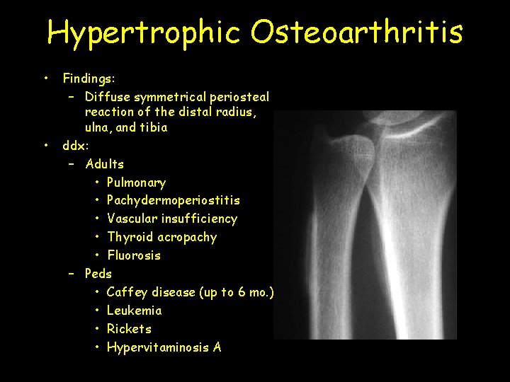 Hypertrophic Osteoarthritis • • Findings: – Diffuse symmetrical periosteal reaction of the distal radius,