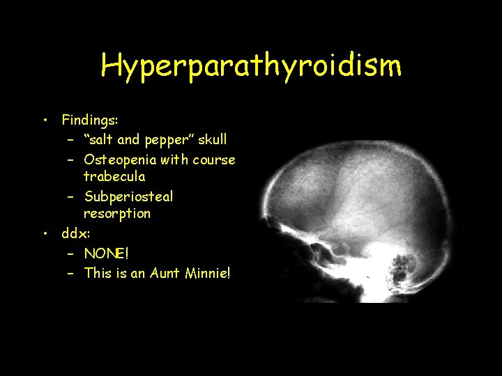 Hyperparathyroidism • Findings: – “salt and pepper” skull – Osteopenia with course trabecula –