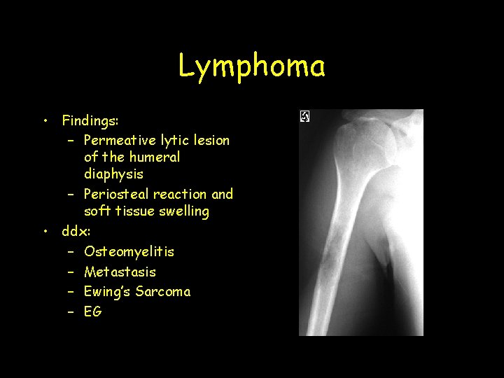 Lymphoma • Findings: – Permeative lytic lesion of the humeral diaphysis – Periosteal reaction