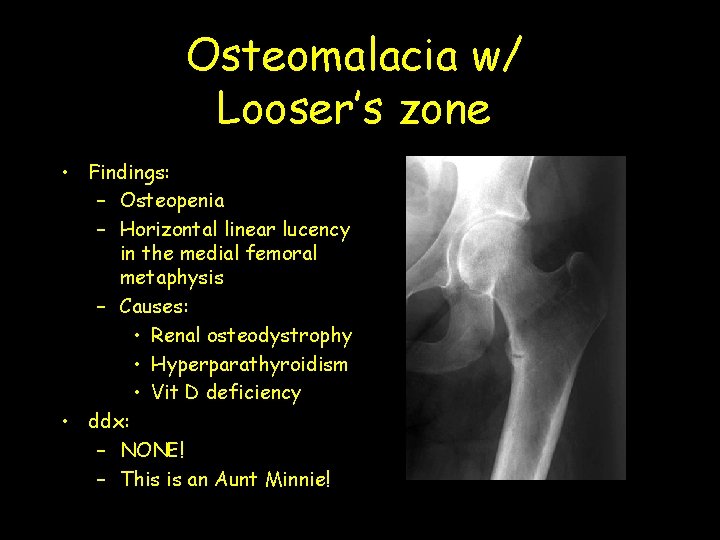 Osteomalacia w/ Looser’s zone • Findings: – Osteopenia – Horizontal linear lucency in the