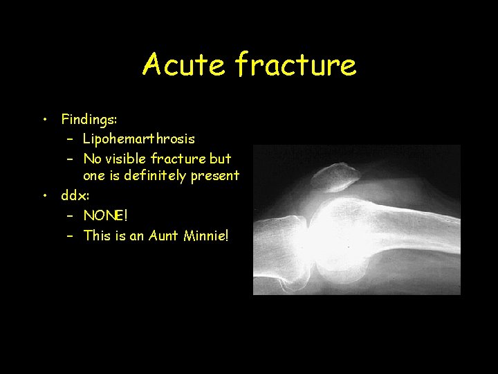 Acute fracture • Findings: – Lipohemarthrosis – No visible fracture but one is definitely