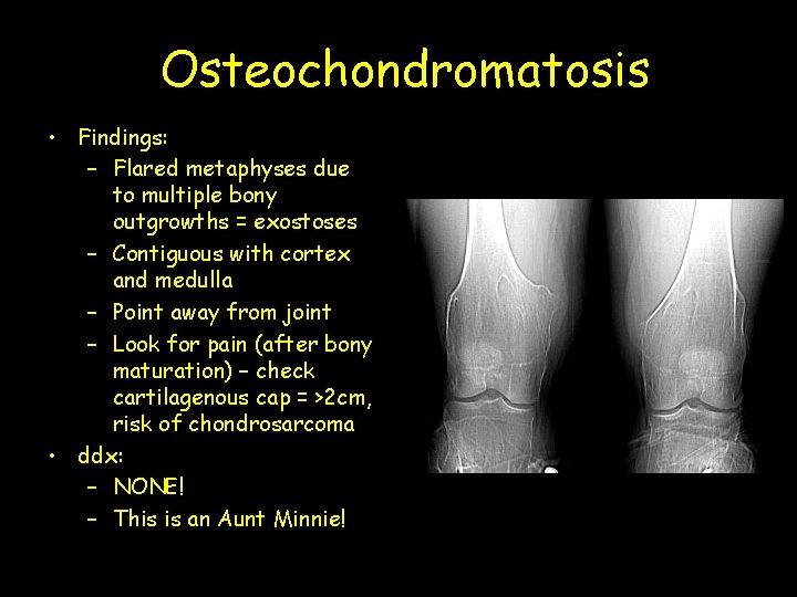 Osteochondromatosis • Findings: – Flared metaphyses due to multiple bony outgrowths = exostoses –