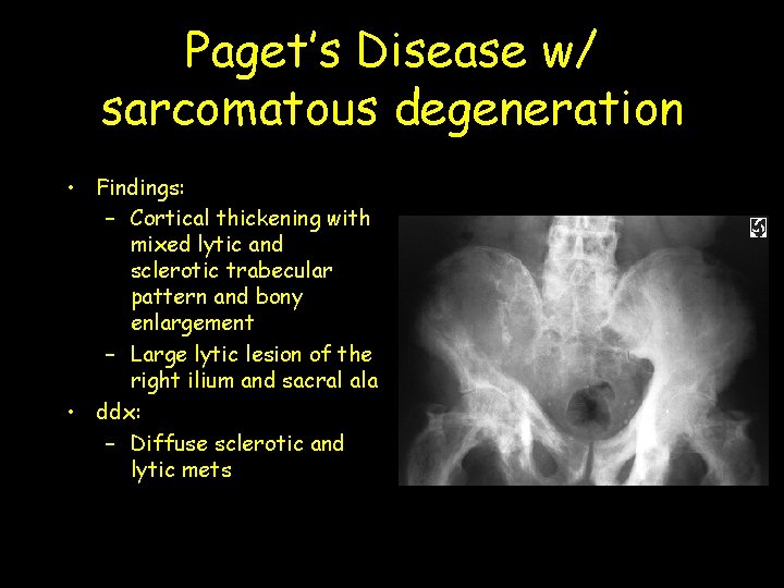 Paget’s Disease w/ sarcomatous degeneration • Findings: – Cortical thickening with mixed lytic and