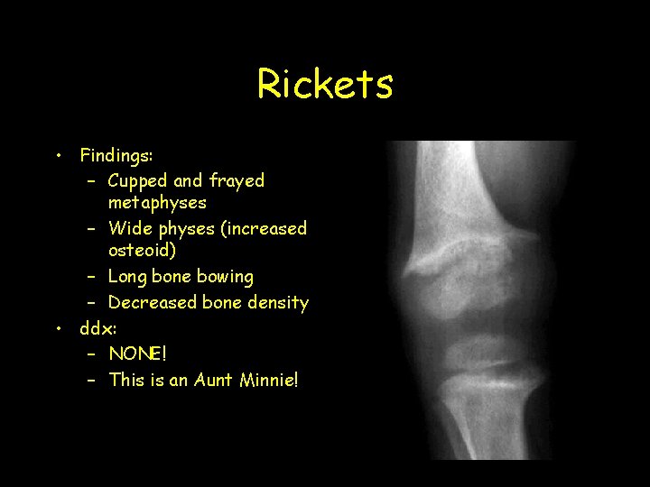 Rickets • Findings: – Cupped and frayed metaphyses – Wide physes (increased osteoid) –