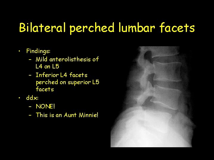 Bilateral perched lumbar facets • Findings: – Mild anterolisthesis of L 4 on L