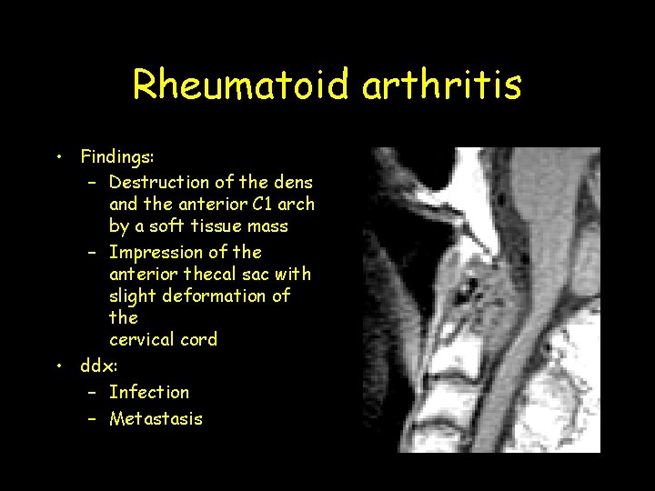 Rheumatoid arthritis • Findings: – Destruction of the dens and the anterior C 1