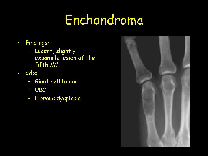 Enchondroma • Findings: – Lucent, slightly expansile lesion of the fifth MC • ddx: