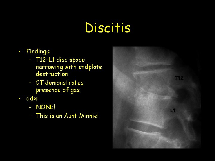 Discitis • Findings: – T 12 -L 1 disc space narrowing with endplate destruction