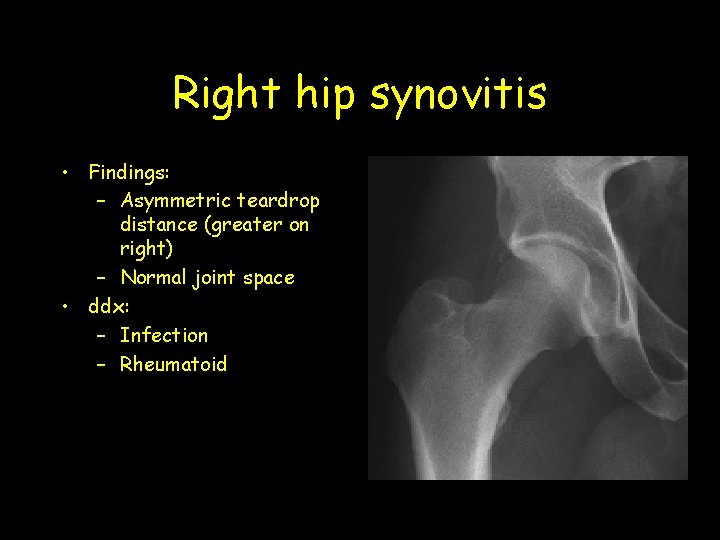 Right hip synovitis • Findings: – Asymmetric teardrop distance (greater on right) – Normal