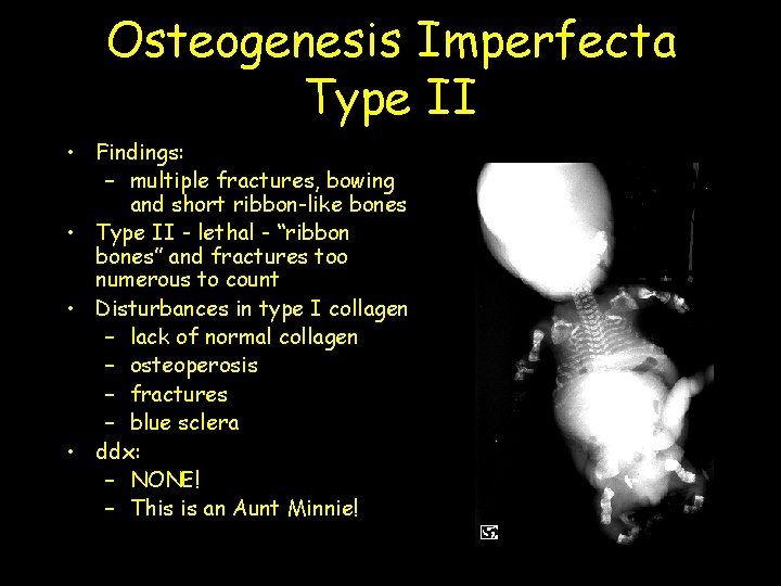 Osteogenesis Imperfecta Type II • Findings: – multiple fractures, bowing and short ribbon-like bones