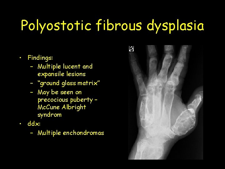 Polyostotic fibrous dysplasia • Findings: – Multiple lucent and expansile lesions – “ground glass