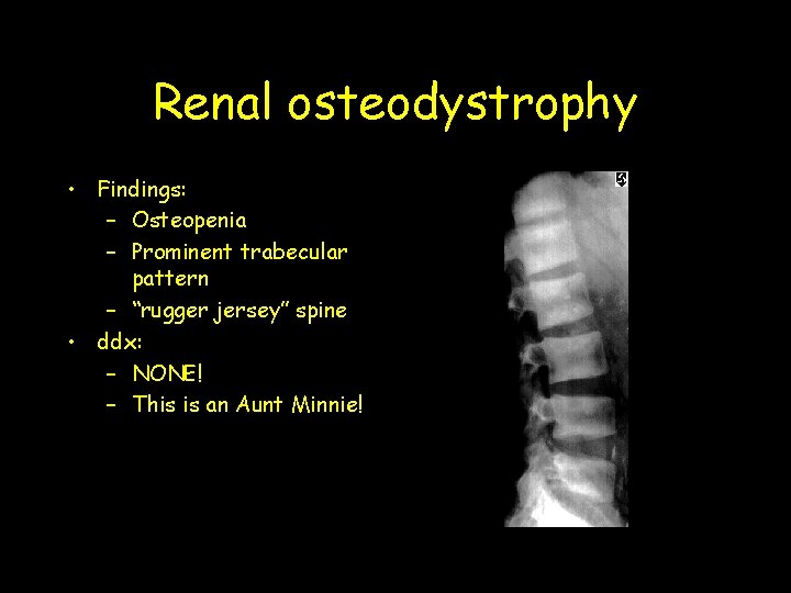 Renal osteodystrophy • Findings: – Osteopenia – Prominent trabecular pattern – “rugger jersey” spine