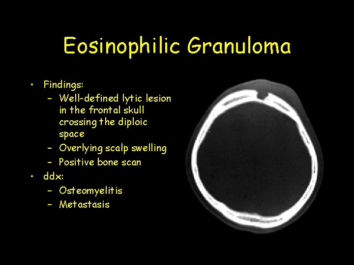 Eosinophilic Granuloma • Findings: – Well-defined lytic lesion in the frontal skull crossing the