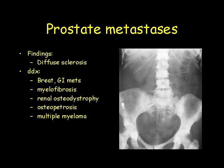 Prostate metastases • Findings: – Diffuse sclerosis • ddx: – Breat, GI mets –
