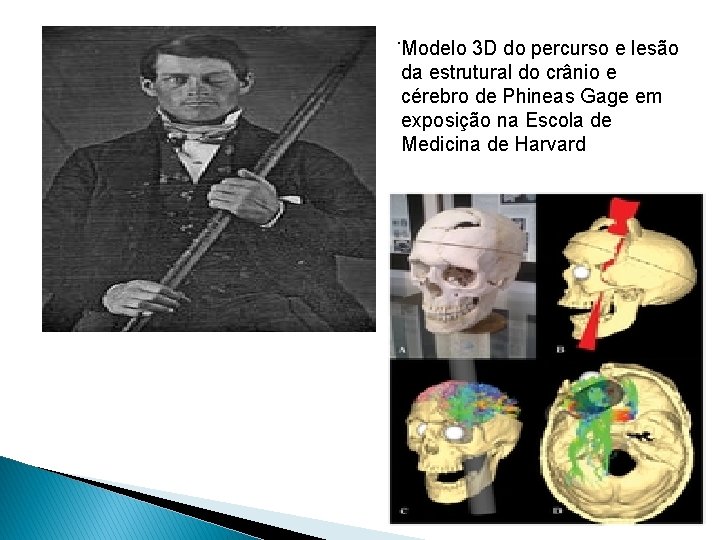 . Modelo 3 D do percurso e lesão da estrutural do crânio e cérebro