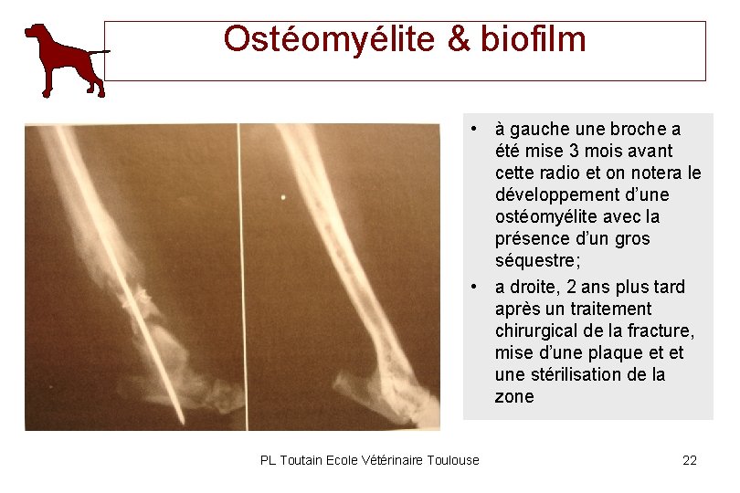 Ostéomyélite & biofilm • à gauche une broche a été mise 3 mois avant