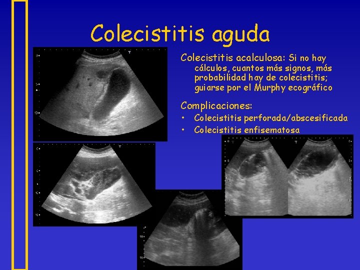 Colecistitis aguda Colecistitis acalculosa: Si no hay cálculos, cuantos más signos, más probabilidad hay