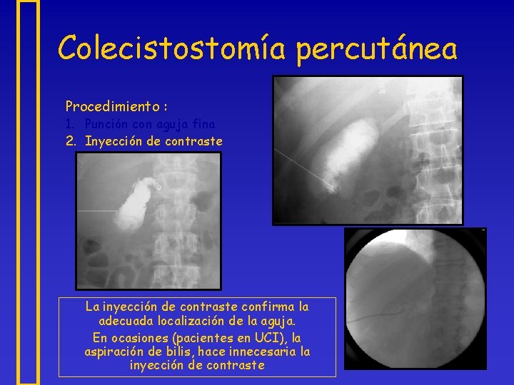 Colecistostomía percutánea Procedimiento : 1. Punción con aguja fina 2. Inyección de contraste La