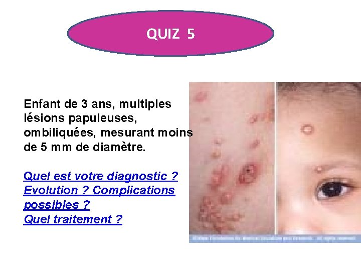 QUIZ 5 Enfant de 3 ans, multiples lésions papuleuses, ombiliquées, mesurant moins de 5