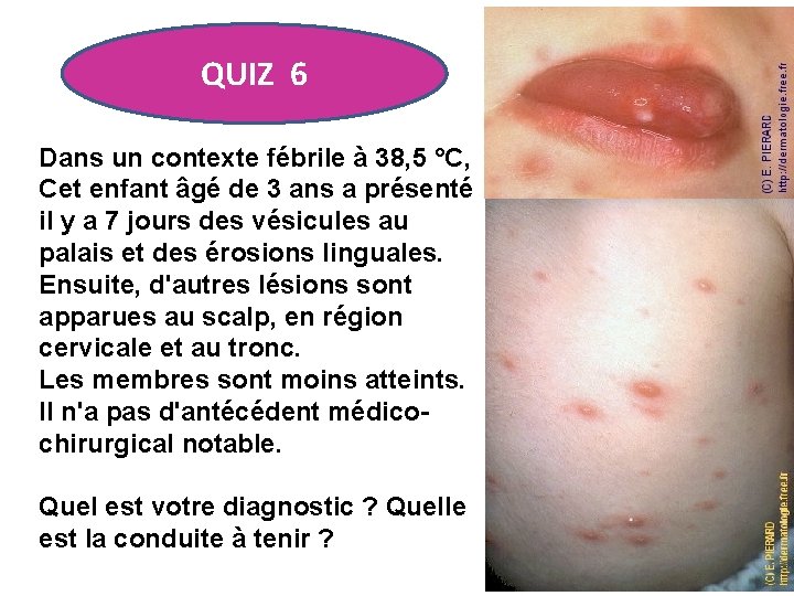 QUIZ 6 Dans un contexte fébrile à 38, 5 °C, Cet enfant âgé de