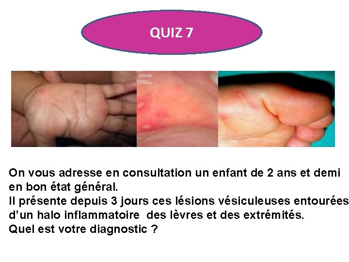 QUIZ 7 On vous adresse en consultation un enfant de 2 ans et demi