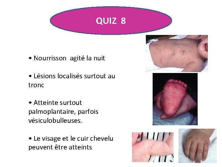 QUIZ 8 • Nourrisson agité la nuit • Lésions localisés surtout au tronc •