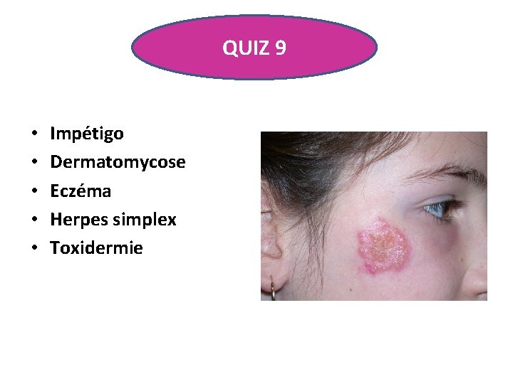 QUIZ 9 • • • Impétigo Dermatomycose Eczéma Herpes simplex Toxidermie 