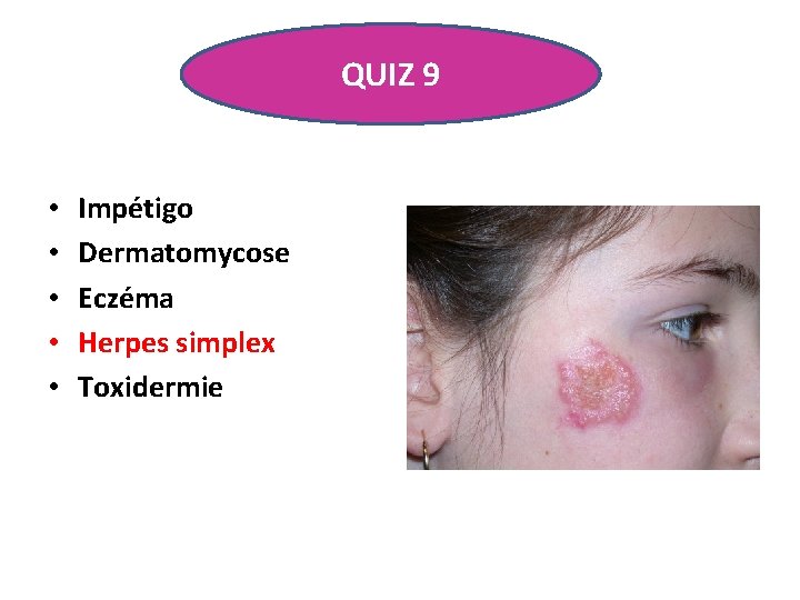 QUIZ 9 • • • Impétigo Dermatomycose Eczéma Herpes simplex Toxidermie 